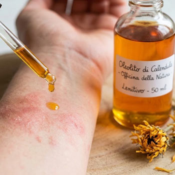 olio calendula irritazioni