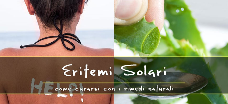 eritemi solari rimedi