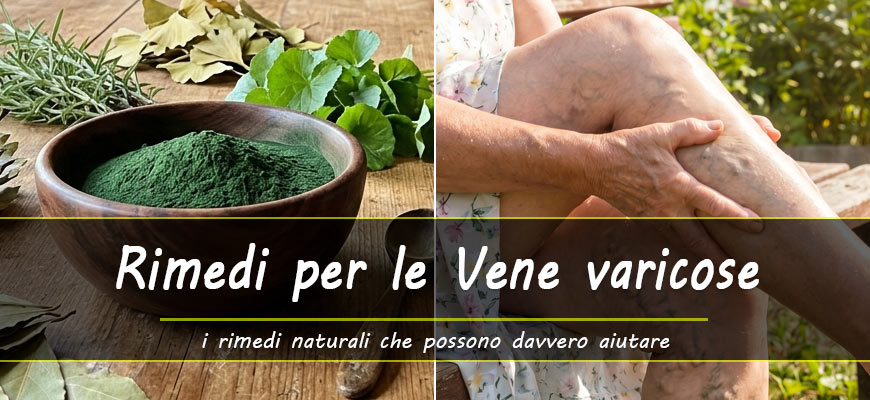 rimedi naturali vene varicose