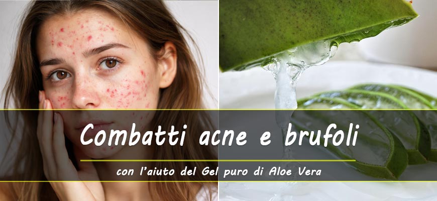 gel aloe vera acne